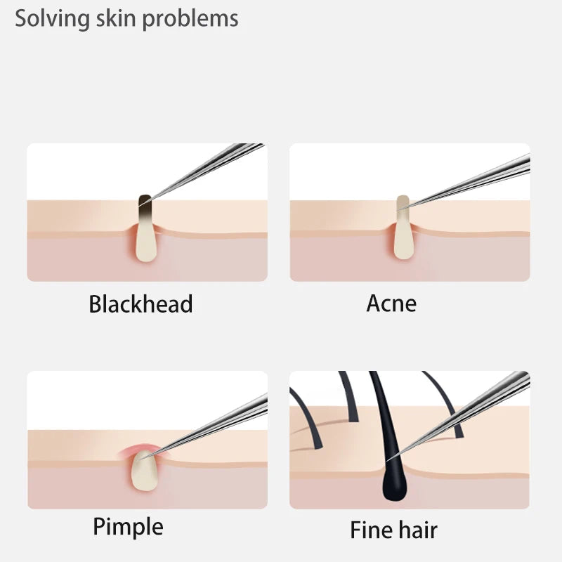 Stainless Steel Blackhead/Blemish Remover Kit