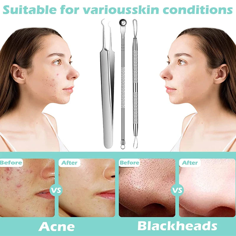 Stainless Steel Blackhead/Blemish Remover Kit